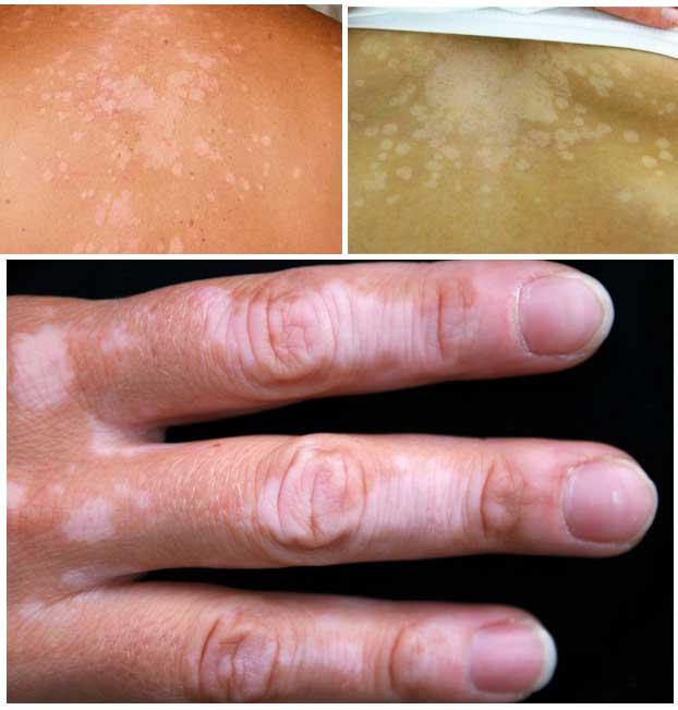 Thuần Mộc điều trị Lang ben