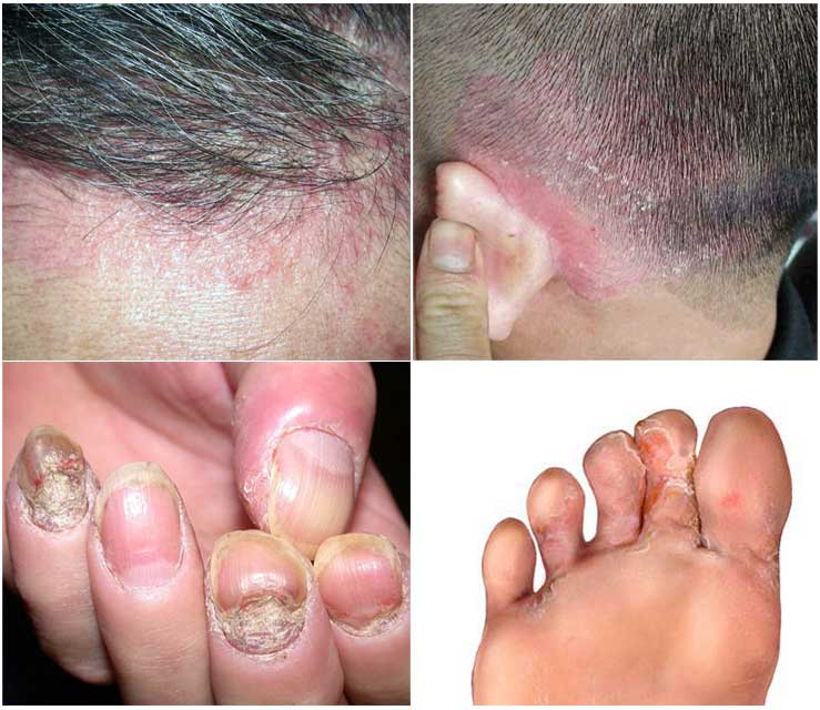 Thuần Mộc điều trị bệnh nấm da, nấm đầu