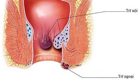 Cao thuần mộc trị trĩ nội trĩ ngoại