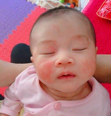 Thuần Mộc điều trị Chàm Sữa