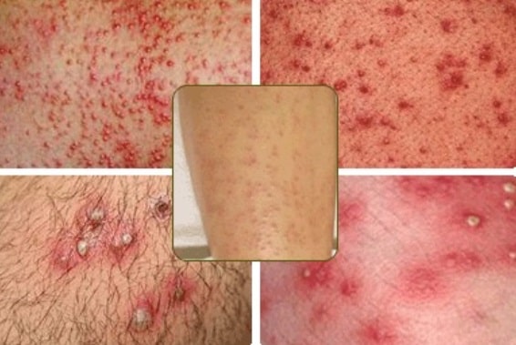 Thuần Mộc điều trị viêm lỗ chân lông, viêm nang lông