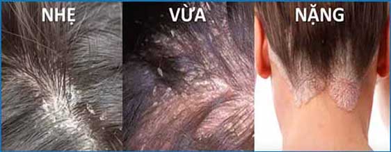 biểu hiện cơ bản của nấm da đầu biểu hiện cơ bản của nấm da đầu