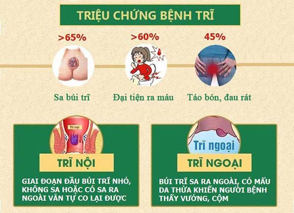 triệu chứng bệnh trĩ